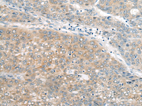 Immunohistochemistry of paraffin-embedded Human liver cancer tissue using UBE2G2 Polyclonal Antibody at dilution of 1:55 (×200)