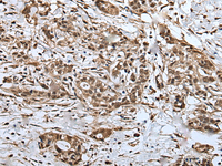 Immunohistochemistry of paraffin-embedded Human gastric cancer tissue using UPK3A Polyclonal Antibody at dilution of 1:30 (×200)