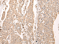 Immunohistochemistry of paraffin-embedded Human prost ate cancer tissue using ATAD3A Polyclonal Antibody at dilution of 1:40 (×200)