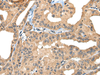 Immunohistochemistry of paraffin-embedded Human thyroid cancer tissue using BHMT2 Polyclonal Antibody at dilution of 1:30 (×200)