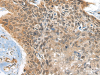 Immunohistochemistry of paraffin-embedded Human esophagus cancer tissue using BOLA1 Polyclonal Antibody at dilution of 1:35 (×200)