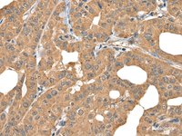 Immunohistochemistry of paraffin-embedded Human thyroid cancer tissue using BOLA1 Polyclonal Antibody at dilution of 1:35 (×200)