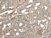 Immunohistochemistry of paraffin-embedded Human liver cancer tissue using MCPH1 Polyclonal Antibody at dilution of 1:110 (×200)