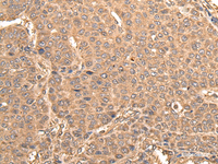 Immunohistochemistry of paraffin-embedded Human liver cancer tissue using BUD31 Polyclonal Antibody at dilution of 1:75 (×200)