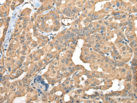 Immunohistochemistry of paraffin-embedded Human thyroid cancer tissue using FAM110B Polyclonal Antibody at dilution of 1:40 (×200)