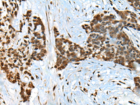 Immunohistochemistry of paraffin-embedded Human thyroid cancer tissue using CCDC12 Polyclonal Antibody at dilution of 1:60 (×200)