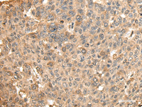 Immunohistochemistry of paraffin-embedded Human liver cancer tissue using HMMR Polyclonal Antibody at dilution of 1:45 (×200)