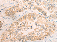 Immunohistochemistry of paraffin-embedded Human gastric cancer tissue using CD86 Polyclonal Antibody at dilution of 1:30 (×200)