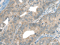 Immunohistochemistry of paraffin-embedded Human gastric cancer tissue using CDADC1 Polyclonal Antibody at dilution of 1:60 (×200)