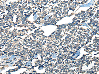 Immunohistochemistry of paraffin-embedded Human lung cancer tissue using CDADC1 Polyclonal Antibody at dilution of 1:60 (×200)