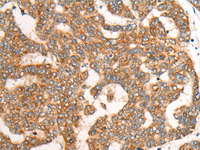 Immunohistochemistry of paraffin-embedded Human liver cancer tissue using CDON Polyclonal Antibody at dilution of 1:65 (×200)