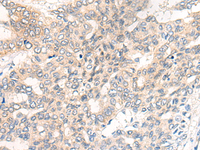 Immunohistochemistry of paraffin-embedded Human liver cancer tissue using CHRD Polyclonal Antibody at dilution of 1:40 (×200)