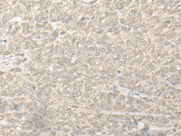 Immunohistochemistry of paraffin-embedded Human ovarian cancer tissue using COMT Polyclonal Antibody at dilution of 1:30 (×200)