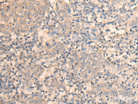 Immunohistochemistry of paraffin-embedded Human cervical cancer tissue using DAZ1 Polyclonal Antibody at dilution of 1:55 (×200)