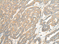 Immunohistochemistry of paraffin-embedded Human liver cancer tissue using ITM2B Polyclonal Antibody at dilution of 1:35 (×200)