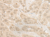 Immunohistochemistry of paraffin-embedded Human esophagus cancer tissue using RSU1 Polyclonal Antibody at dilution of 1:30 (×200)