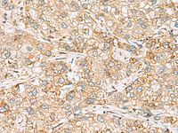 Immunohistochemistry of paraffin-embedded Human liver cancer tissue using SH3GL2 Polyclonal Antibody at dilution of 1:80 (×200)