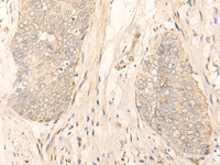 Immunohistochemistry of paraffin-embedded Human esophagus cancer tissue using GK5 Polyclonal Antibody at dilution of 1:35 (×200)