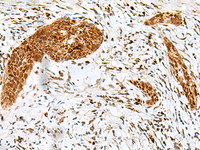 Immunohistochemistry of paraffin-embedded Human esophagus cancer tissue using HMG20A Polyclonal Antibody at dilution of 1:25 (×200)