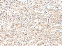 Immunohistochemistry of paraffin-embedded Human liver cancer tissue using SMS Polyclonal Antibody at dilution of 1:50 (×200)