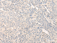 Immunohistochemistry of paraffin-embedded Human cervical cancer tissue using RADIL Polyclonal Antibody at dilution of 1:40 (×200)