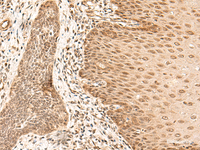 Immunohistochemistry of paraffin-embedded Human esophagus cancer tissue using ARMC8 Polyclonal Antibody at dilution of 1:40 (×200)