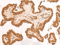 Immunohistochemistry of paraffin-embedded Human thyroid cancer tissue using ARMC8 Polyclonal Antibody at dilution of 1:40 (×200)