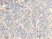 Immunohistochemistry of paraffin-embedded Human cervical cancer tissue using PARS2 Polyclonal Antibody at dilution of 1:30 (×200)