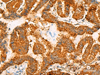 Immunohistochemistry of paraffin-embedded Human thyroid cancer tissue using ASMTL Polyclonal Antibody at dilution of 1:100 (×200)