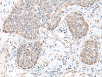 Immunohistochemistry of paraffin-embedded Human esophagus cancer tissue using TCF25 Polyclonal Antibody at dilution of 1:35 (×200)