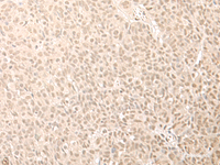 Immunohistochemistry of paraffin-embedded Human esophagus cancer tissue using CNOT10 Polyclonal Antibody at dilution of 1:50 (×200)
