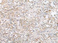 Immunohistochemistry of paraffin-embedded Human liver cancer tissue using PFKM Polyclonal Antibody at dilution of 1:60 (×200)