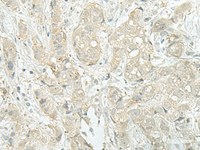 Immunohistochemistry of paraffin-embedded Human breast cancer tissue using MIEN1 Polyclonal Antibody at dilution of 1:45 (×200)