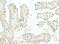 Immunohistochemistry of paraffin-embedded Human thyroid cancer tissue using MIEN1 Polyclonal Antibody at dilution of 1:45 (×200)