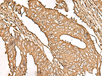 Immunohistochemistry of paraffin-embedded Human colorectal cancer tissue using UBE2A Polyclonal Antibody at dilution of 1:45 (×200)