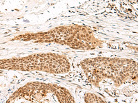 Immunohistochemistry of paraffin-embedded Human esophagus cancer tissue using MDFI Polyclonal Antibody at dilution of 1:55 (×200)