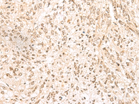 Immunohistochemistry of paraffin-embedded Human liver cancer tissue using MDFI Polyclonal Antibody at dilution of 1:55 (×200)