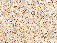 Immunohistochemistry of paraffin-embedded Human prost ate cancer tissue using PSMA3 Polyclonal Antibody at dilution of 1:50 (×200)