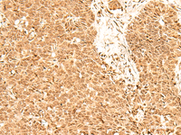 Immunohistochemistry of paraffin-embedded Human ovarian cancer tissue using ADRM1 Polyclonal Antibody at dilution of 1:70 (×200)