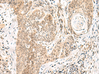 Immunohistochemistry of paraffin-embedded Human esophagus cancer tissue using GPSM1 Polyclonal Antibody at dilution of 1:55 (×200)