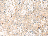 Immunohistochemistry of paraffin-embedded Human ovarian cancer tissue using GPSM1 Polyclonal Antibody at dilution of 1:55 (×200)