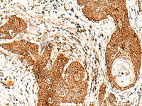Immunohistochemistry of paraffin-embedded Human esophagus cancer tissue using SMOC1 Polyclonal Antibody at dilution of 1:50 (×200)