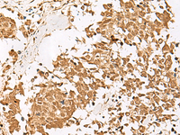 Immunohistochemistry of paraffin-embedded Human lung cancer tissue using PSMD12 Polyclonal Antibody at dilution of 1:40 (×200)