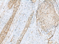 Immunohistochemistry of paraffin-embedded Human esophagus cancer tissue using TEX11 Polyclonal Antibody at dilution of 1:30 (×200)