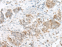 Immunohistochemistry of paraffin-embedded Human esophagus cancer tissue using PLCL2 Polyclonal Antibody at dilution of 1:50 (×200)