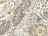 Immunohistochemistry of paraffin-embedded Human esophagus cancer tissue using NUTF2 Polyclonal Antibody at dilution of 1:110 (×200)