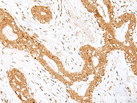 Immunohistochemistry of paraffin-embedded Human breast cancer tissue using GOLGA7 Polyclonal Antibody at dilution of 1:40 (×200)