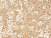 Immunohistochemistry of paraffin-embedded Human ovarian cancer tissue using ILF3 Polyclonal Antibody at dilution of 1:60 (×200)