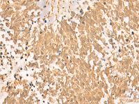 Immunohistochemistry of paraffin-embedded Human lung cancer tissue using UBD Polyclonal Antibody at dilution of 1:50 (×200)