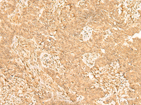 Immunohistochemistry of paraffin-embedded Human ovarian cancer tissue using ST8SIA4 Polyclonal Antibody at dilution of 1:50 (×200)